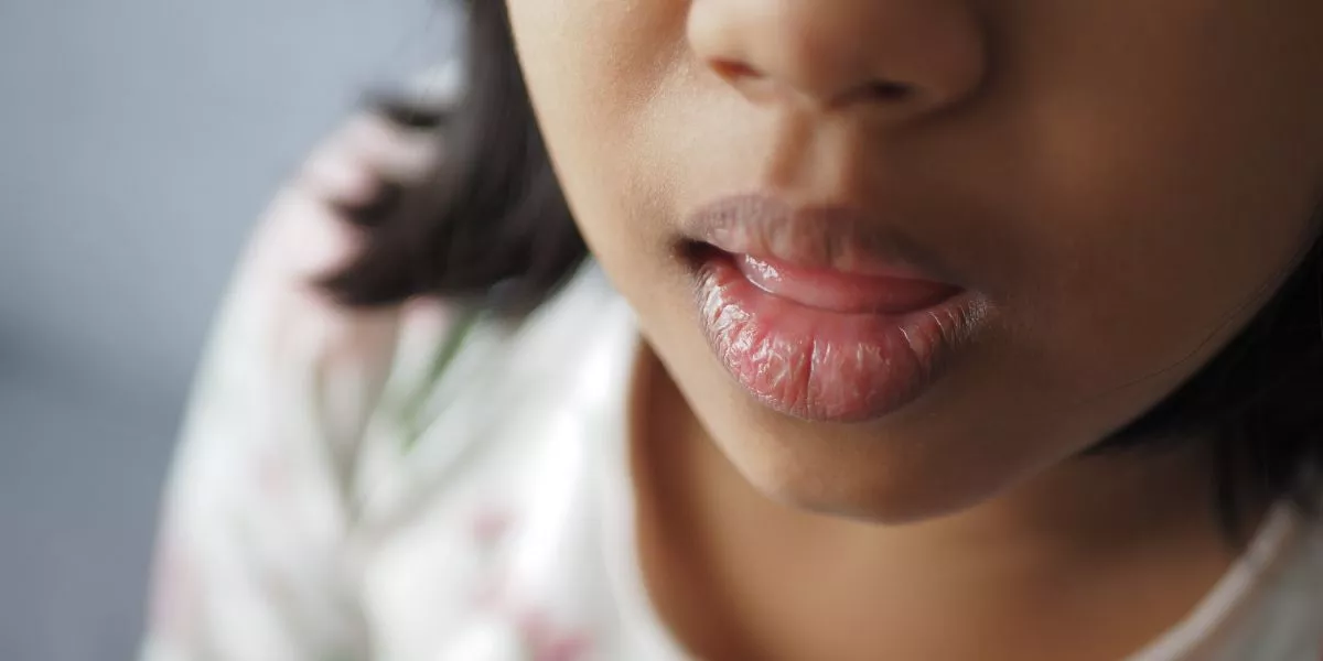 How Can I Prevent and Treat Dry, Cracked Lips?