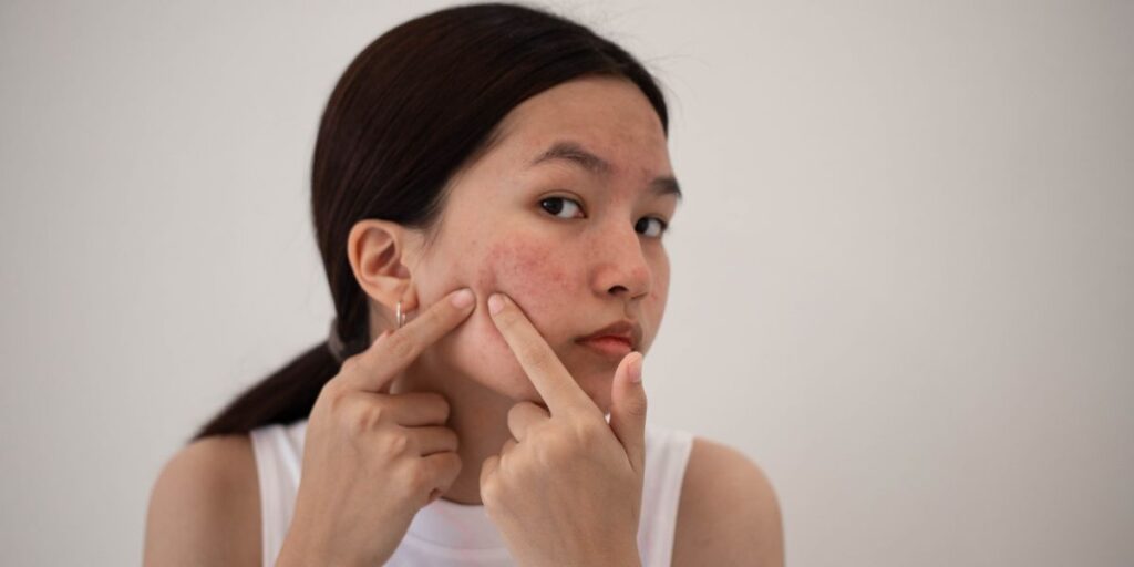 What Are the Best Skincare Products for Acne-Prone Skin? What Are the Best Skincare Products for Acne-Prone Skin?