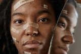 What Are Some Natural Remedies for Acne, Dryness, or Sensitivity?